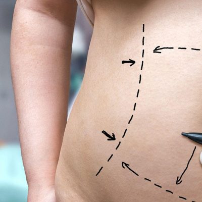 All You Need To Know About The Tummy Tuck Surgery for Women