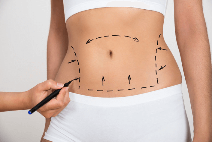 tummy tuck surgery