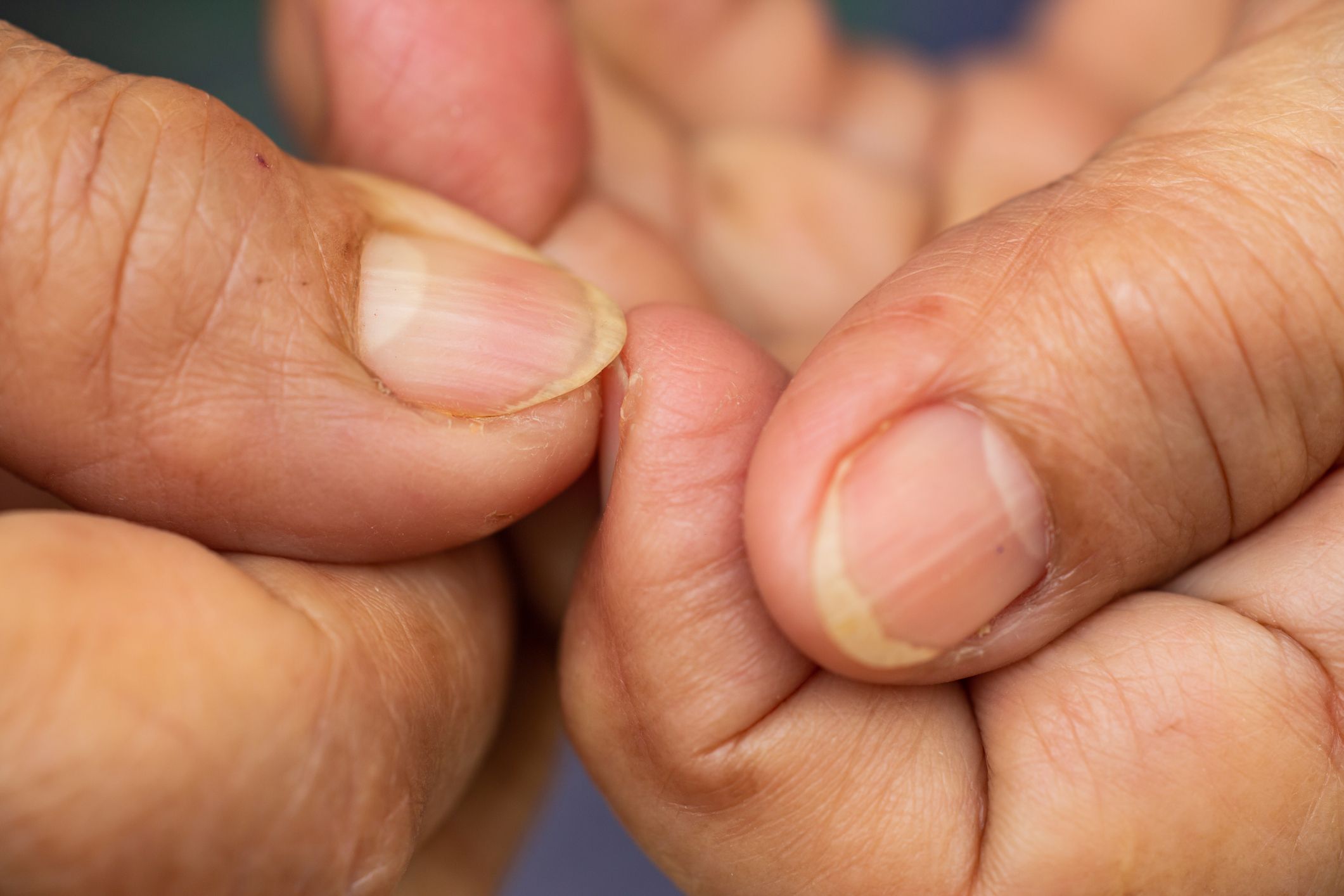 Yellow nail syndrome | CMAJ