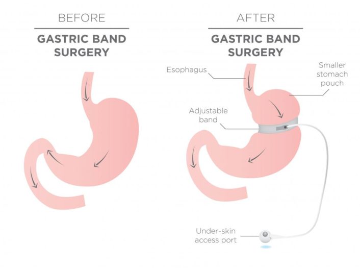gastric_band