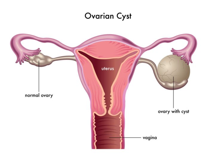 cyst