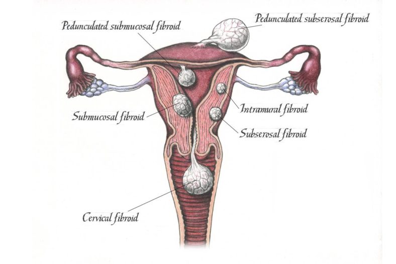 fibroid