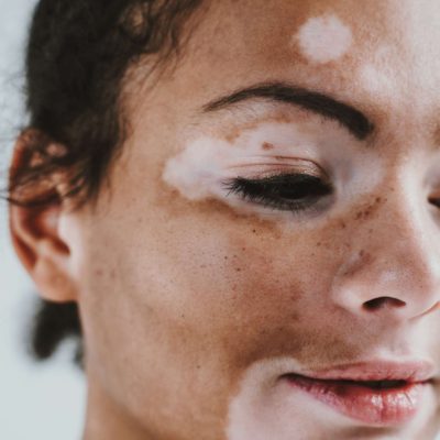 Is Vitiligo Genetic? Time to Know more