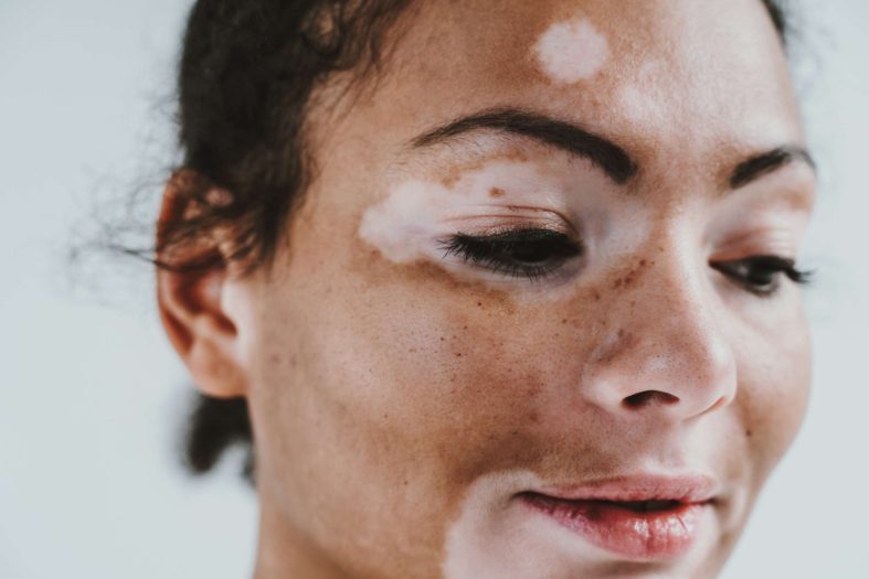 vitiligo